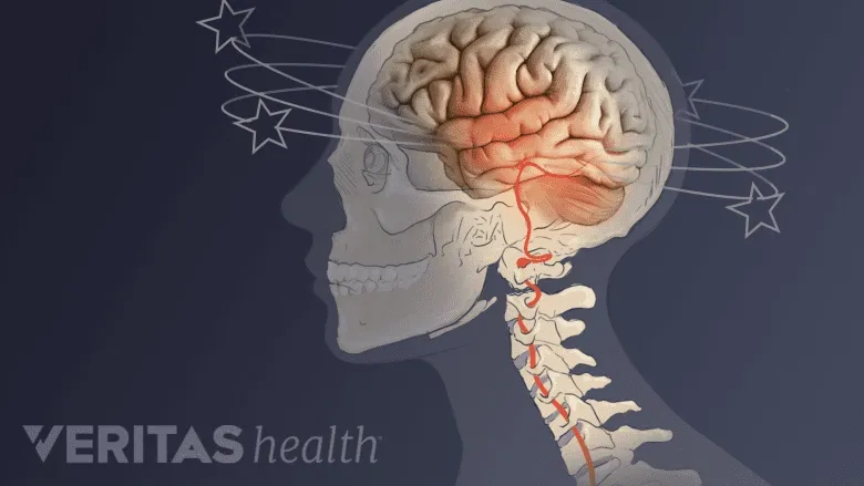 Illustration showing cervicogenic headache symptoms with highlighted brain pain areas, cervical spine, and dizziness stars.