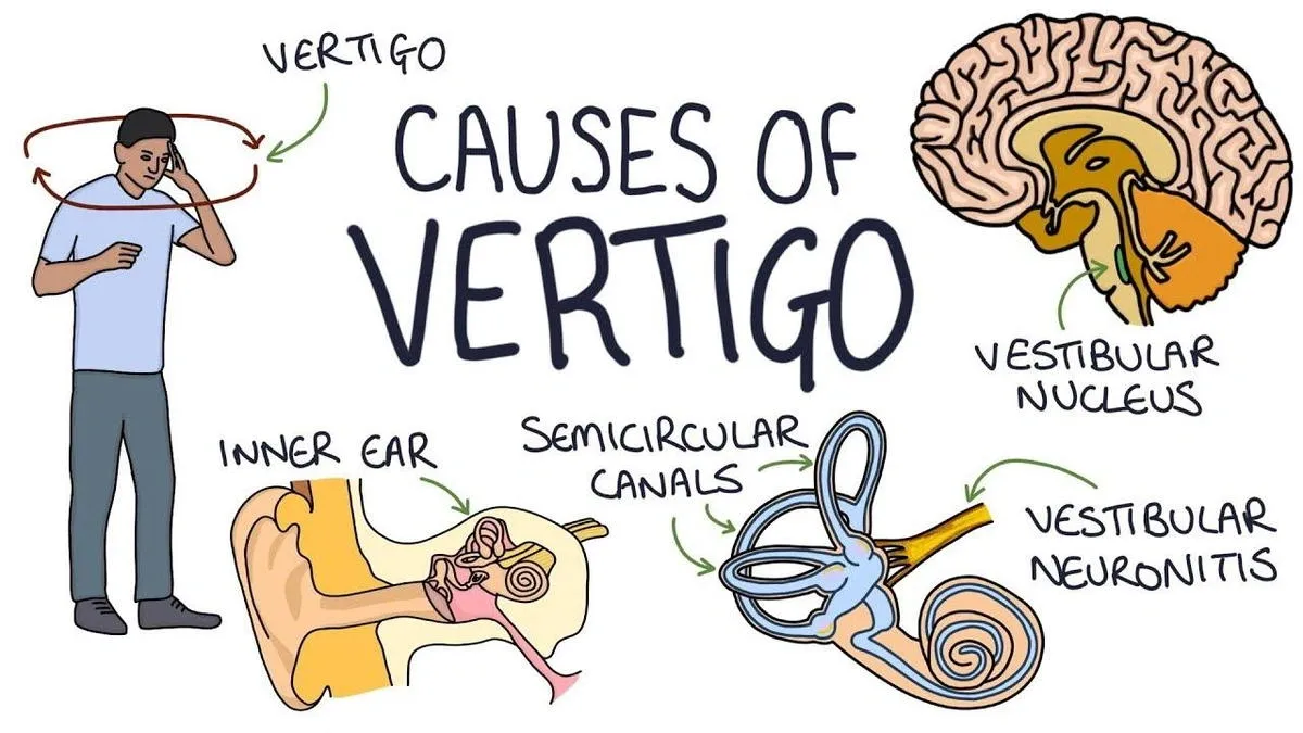 Illustration showing causes of vertigo including inner ear, semicircular canals, vestibular nucleus, and vestibular neuronitis.